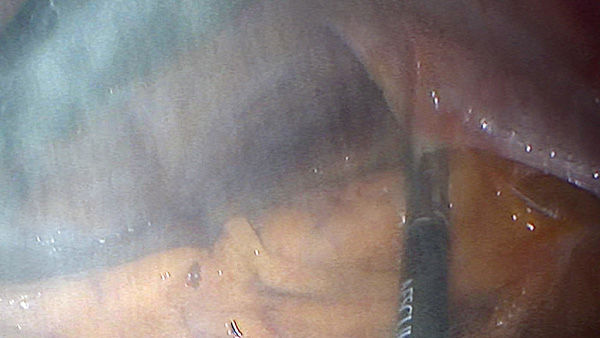 EinsteinVision® in der laparoskopischen Chirurgie mit Rauchreduktion