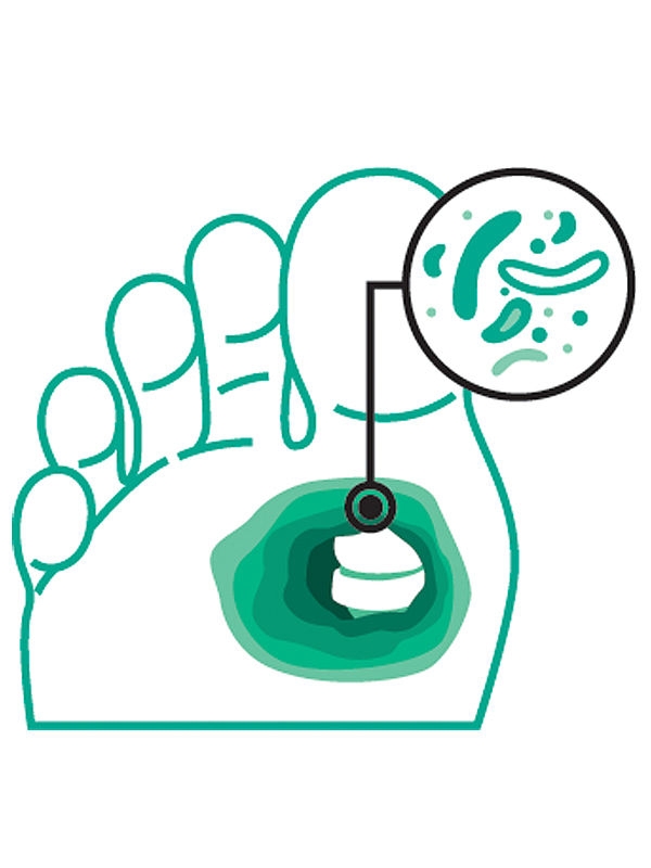 Fußsymbol mit größerem hervorgehobenem Bereich und Bakterien im Knochen, was auf eine mäßige Infektion hindeutet.