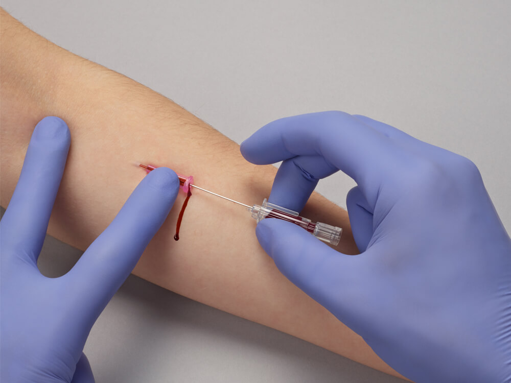 Blut fließt durch falschen Patientenzugang entlang des Arms