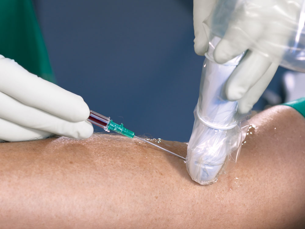 Eine medizinische Fachkraft mit Handschuhen platziert die Introcan Safety® Deep Access Kanüle unter Ultraschallkontrolle. Blutkammer ist mit Blut gefüllt.