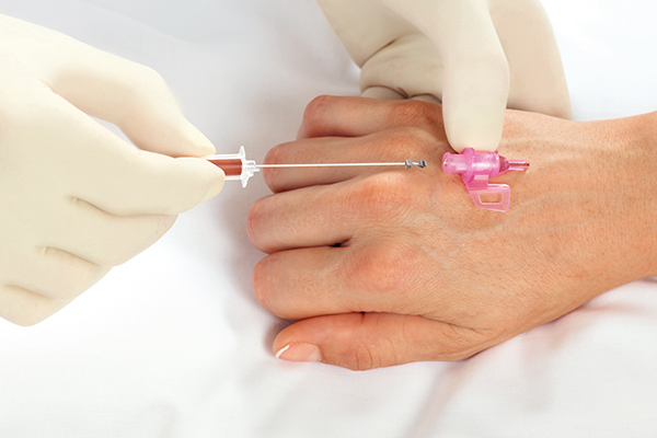 Entfernen der Stahlnadel einer Introcan Safety® 3-Kanüle, die von einer medizinischen Fachkraft mit Handschuhen eingeführt wird. Blutkammer ist mit Blut gefüllt.